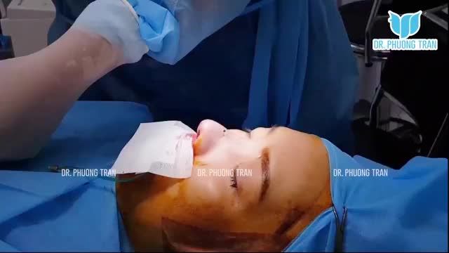 VÀO PHÒNG PH.Ẫ.U THU.ẬT “SOI” KẾT QUẢ NÂNG MŨI CẤU TRÚC!!!