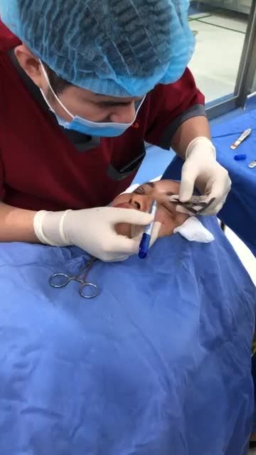 Mí dưới chảy xệ Mí trên chùng