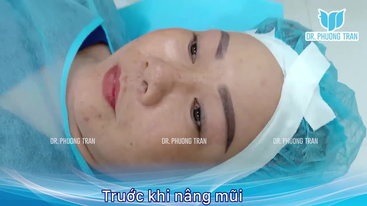 “Biết làm mũi đẹp vậy chị đã làm lâu rồi”