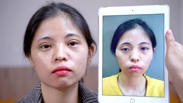 Đôi mắt nhược cơ sụp mí bẩm sinh tạo cảm giác u sâu, già nua được giải phóng sau khi thực hiện Cắt mí bệnh lý bẩm sinh MK tại Dr.Hải Lê