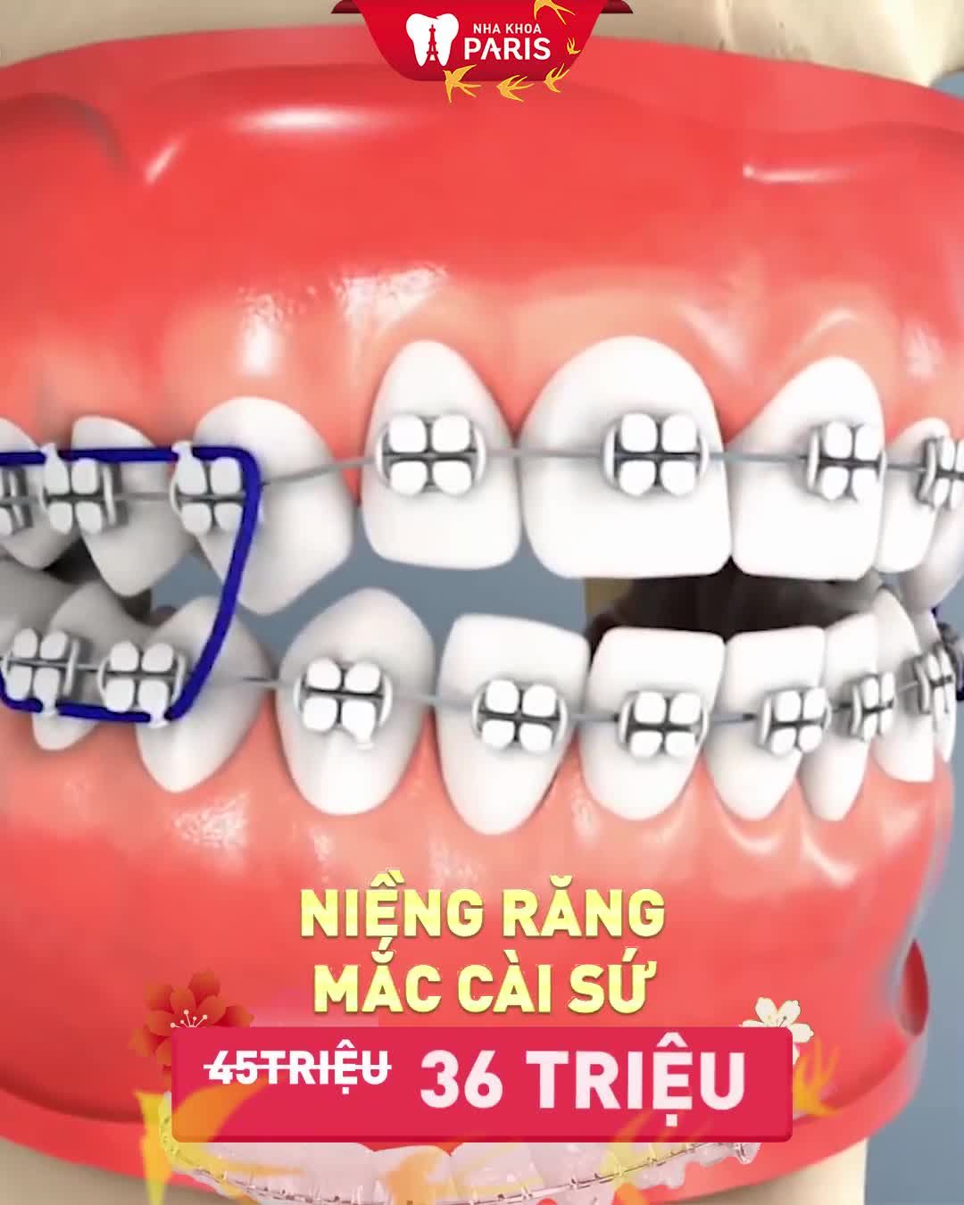 Niềng răng ngay Nhận giá tốt liền tay