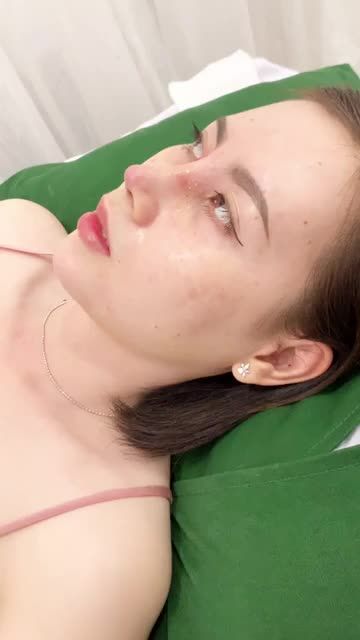 Ca nâng mũi cấu trúc và bọc thêm da sinh học vừa hoàn thành được 10 ngày tại trung tâm Bác sĩ Khải