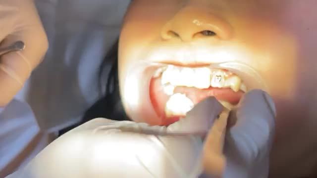 Gắn mắc cài cho bệnh nhân răng CẮN ĐỐI ĐỈNH