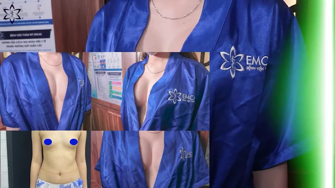 KHE NGỰC HOÀN HẢO BẦU NGỰC CĂNG TRÒN KHÁCH HÀNG TÁI KHÁM NÂNG NGỰC SAU 2 THÁNG