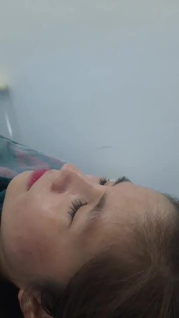 Nâng mũi Bán cấu trúc sụn tai đa lớp Khách hàng tái khám sau 1 tháng phẫu thuật.