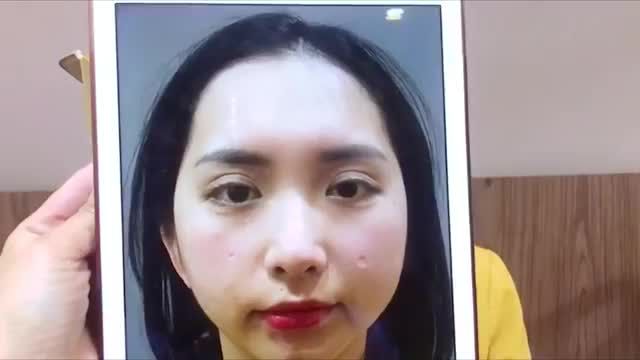 Bất cứ ca mí lỗi hỏng khó đến mức độ nào Dr.Hải Lê đều có thể khắc phục cho bạn