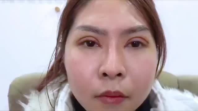 Bây giờ Cắt mí có kịp Tết không? Theo dõi video kết quả sau 7 ngày cắt mí tại Dr.Hải Lê để có thêm động lực bạn nhé
