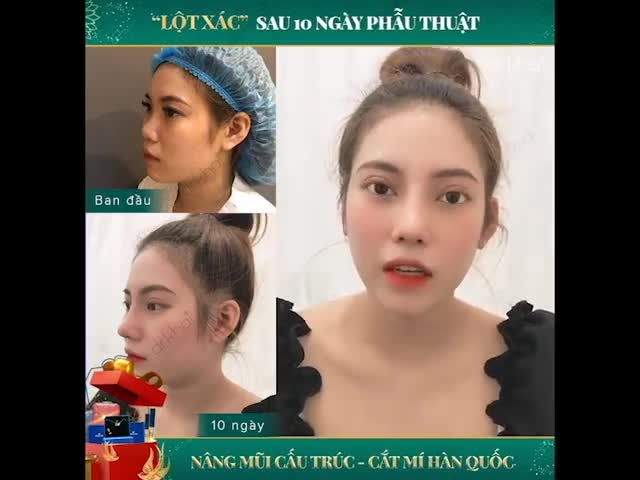 Lột Xác sau 10 ngày phẫu thuật