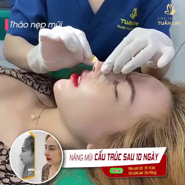 NÂNG MŨI CẤU TRÚC 22TR500 ĐẸP NGAY SAU 10 NGÀY