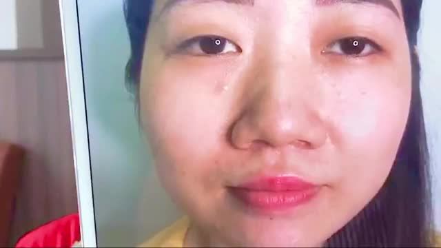 Ngỡ ngàng trước vẻ đẹp rạng rỡ tươi trẻ của khách hàng sau 7 ngày Cắt mí tại chi nhánh TP.HCM