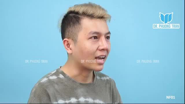 NÂNG MŨI QUÁ CAO SO VỚI SỨC CHỊU ĐỰNG CỦA MÔ DA CHIA SẺ THỰC TẾ TỪ KHÁCH HÀNG