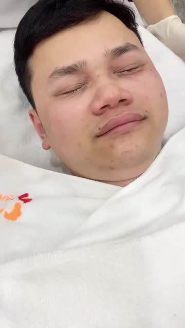 MỤN THỊT chi chít vùng mắt, lan nhanh không kiểm soát