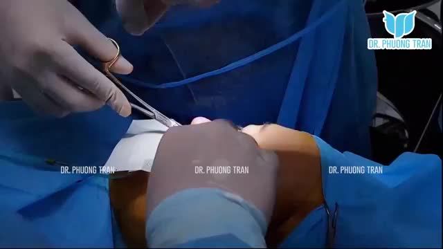KẾT QUẢ THỰC TẾ SAU 60 PHÚT NÂNG MŨI CẤU TRÚC SURGIFORM