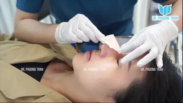 THÁO NẸP SAU 7 NGÀY NÂNG MŨI SỤN SƯỜN CẮT MÍ