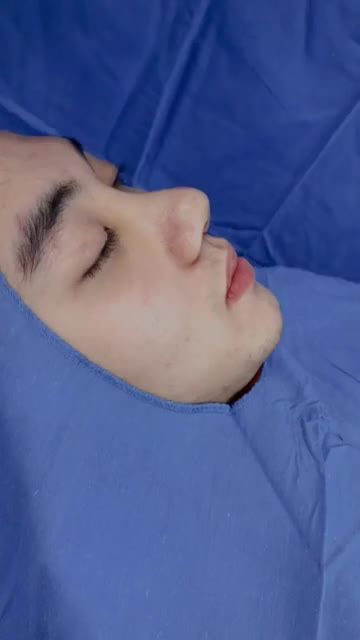 MŨI lệch, sập vách ngăn do tai nạn