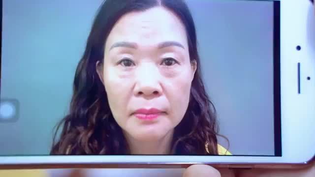 Ca sớm khoe cho cả nhà chiêm ngưỡng ca Cắt mí dưới đẹp tự nhiên chỉ sau 30 phút thực hiện