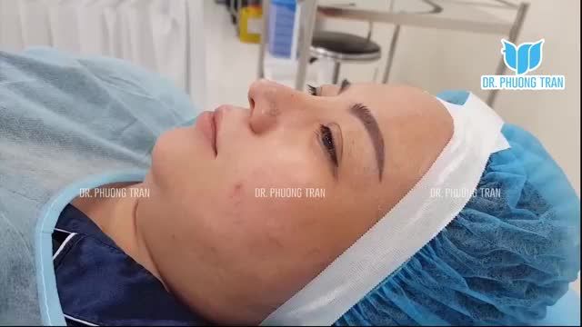 ĐỘN CẰM CÓ ĐAU KHÔNG? SỰ THAY ĐỔI SẼ THẾ NÀO?