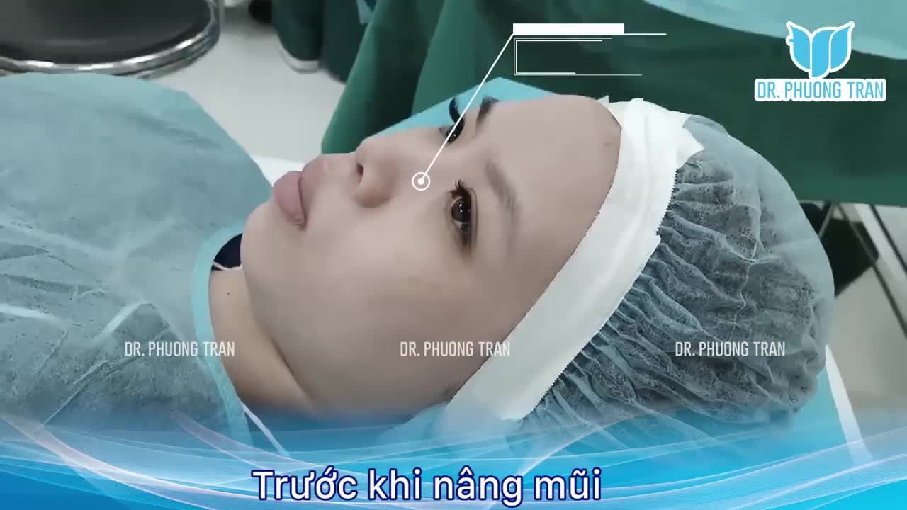 Bị chứng sợ kim và cảm nhận sau nâng mũi