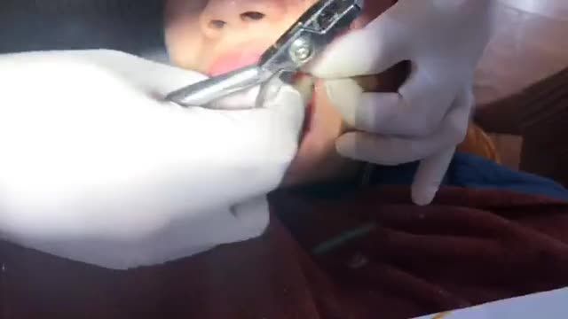 BUNG LỤA CHO KHÁCH HÀNG ĐỖ NGỌC BÍCH SAU NIỀNG RĂNG HÔ  KHẤP KHỂNH