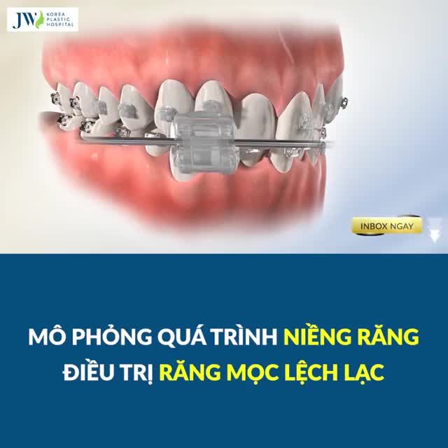 Cách tốt nhất để thoát khỏi răng mọc lệch lạc là đi niềng lại nó!
