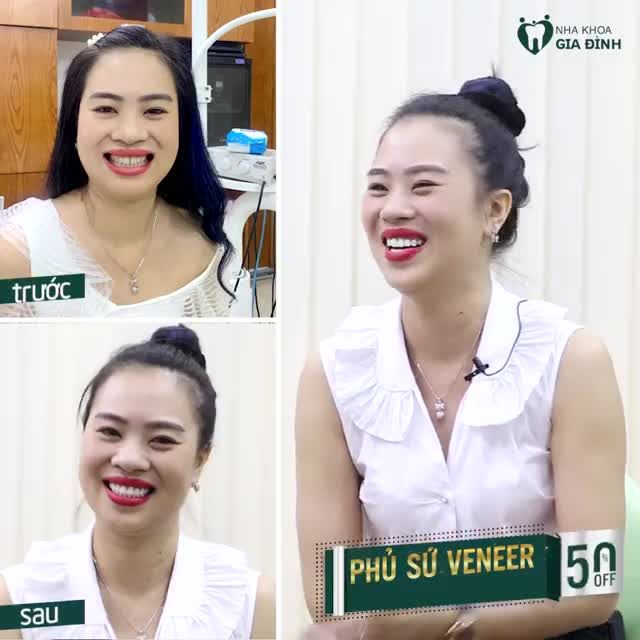 DÁN SỨ VENEER: NHANH NHƯ CHỚP SỞ HỮU NỤ CƯỜI ƯNG Ý