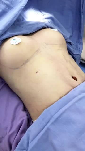 Kết quả combo Lipo nâng ngực