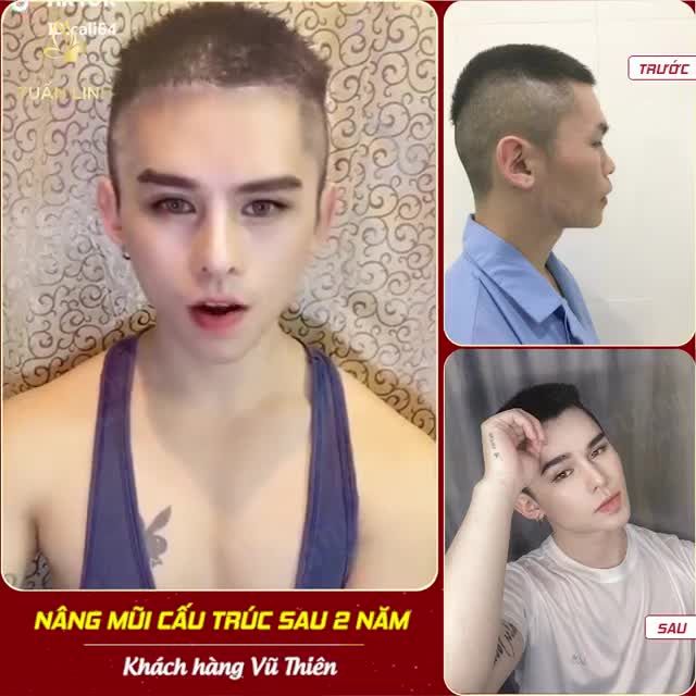NÂNG MŨI CẤU TRÚC SAU 2 NĂM  VẪN " ĐẸP KHÔNG TÌ VẾT"