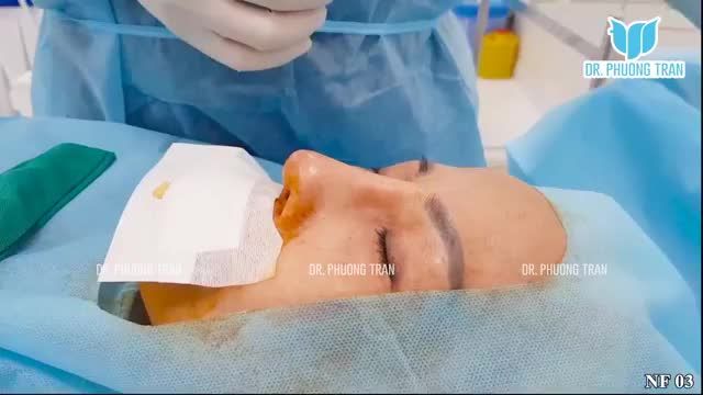 NÂNG MŨI QUÁ CAO VỚI SỨC CĂNG CỦA MÔ DA: HỆ LỤY VÀ CÁCH KHẮC PHỤC HIỆU QUẢ