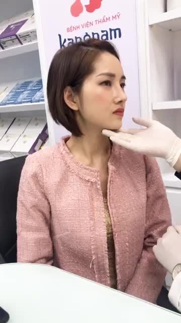 Chị nhân viên nhà Kang Nam sau 1 tháng thực hiện combo CẤY MỠ MẶT và NÂNG MŨI