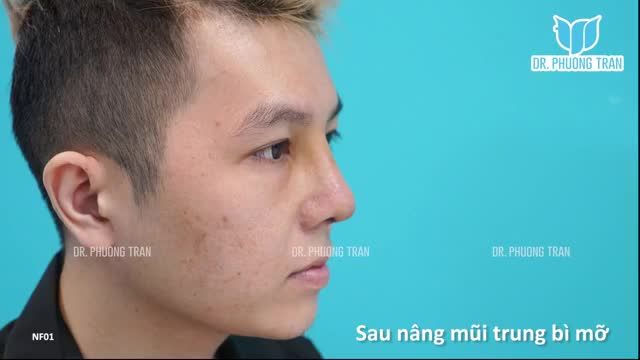 CÓ MỘT ANH DUY RẤT KHÁC CHỈ SAU 4 NGÀY ĐẶT TRUNG BÌ MỠ KHẮC PHỤC MŨI BỊ VIÊM, BÓNG ĐỎ