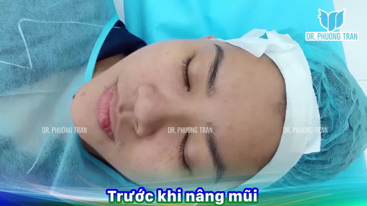 Nhìn hình ảnh so sánh trực tiếp như thế này bạn mới thấy rõ “quyền năng” của nâng mũi cấu trúc.Khác biệt ngay chỉ sau 60 phút phẫu thuật.