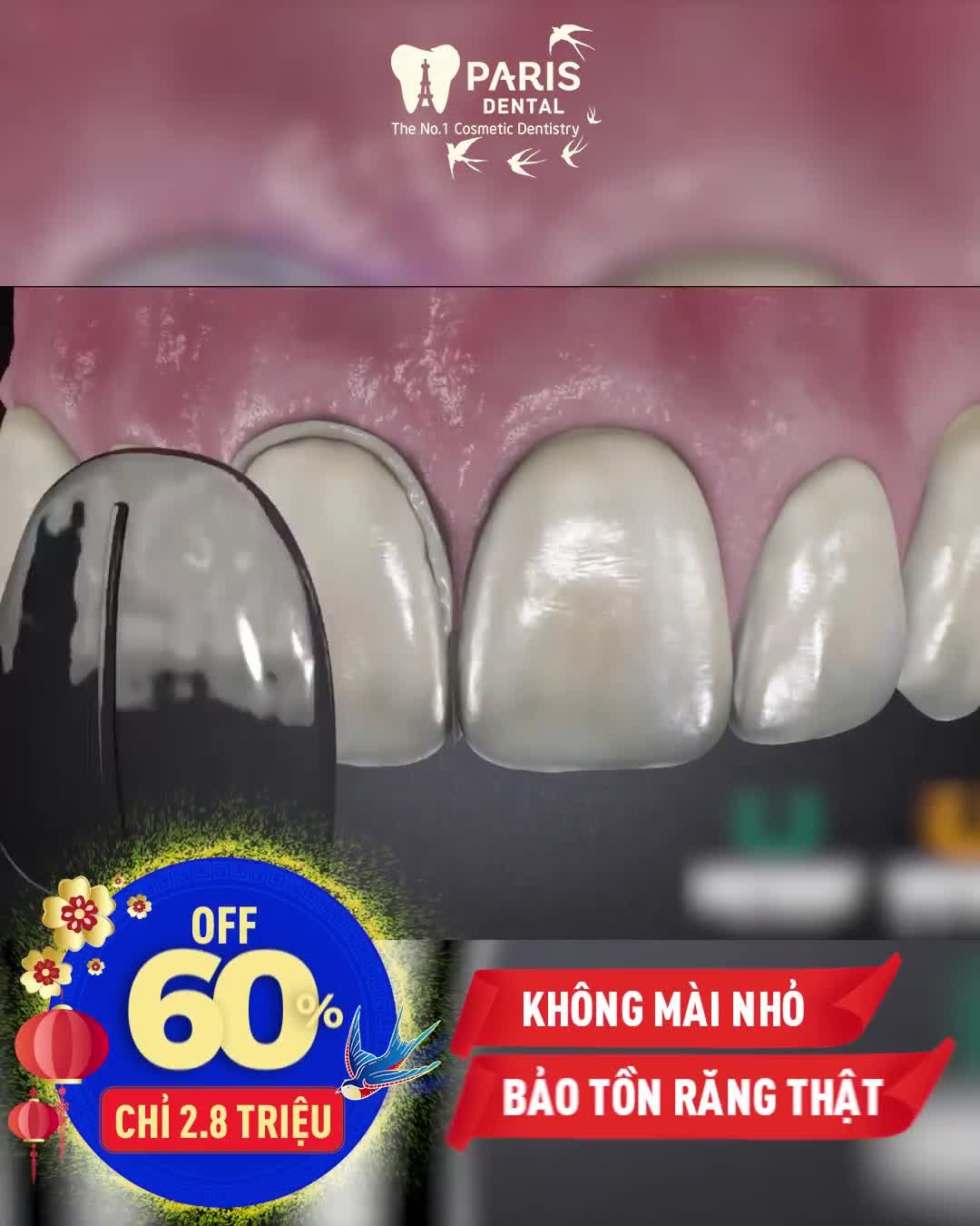 Bọc sứ chuẩn Pháp Độc Quyền