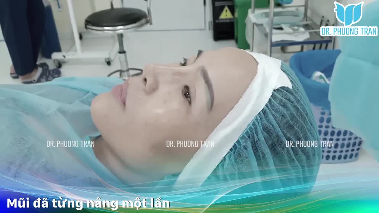 Một ca sửa mũi lệch mang đến nhiều tâm tư