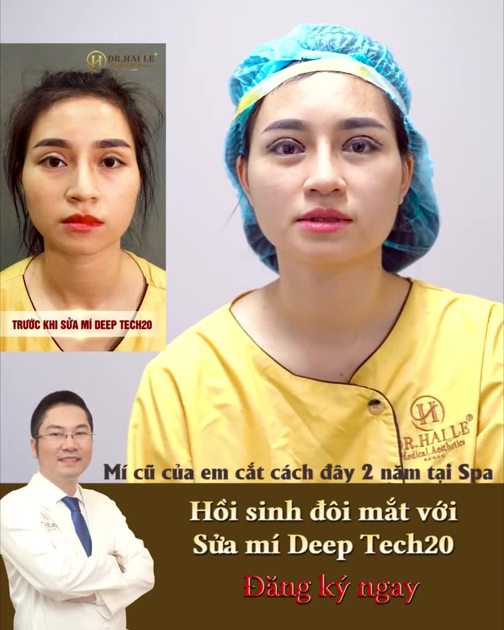 Thành quả tuyệt vời ngay sau khi sửa mí Deep Tech20 tại Dr.Hải Lê