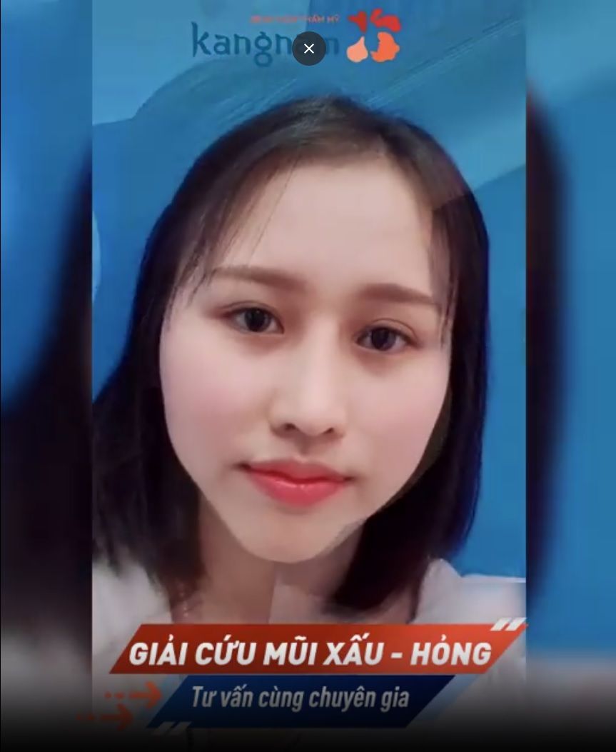 Pha giải cứu MŨI LỆCH đẳng cấp Kangnam Mũi đẹp tự nhiên Mọi góc độ Chỉ 60 phút!