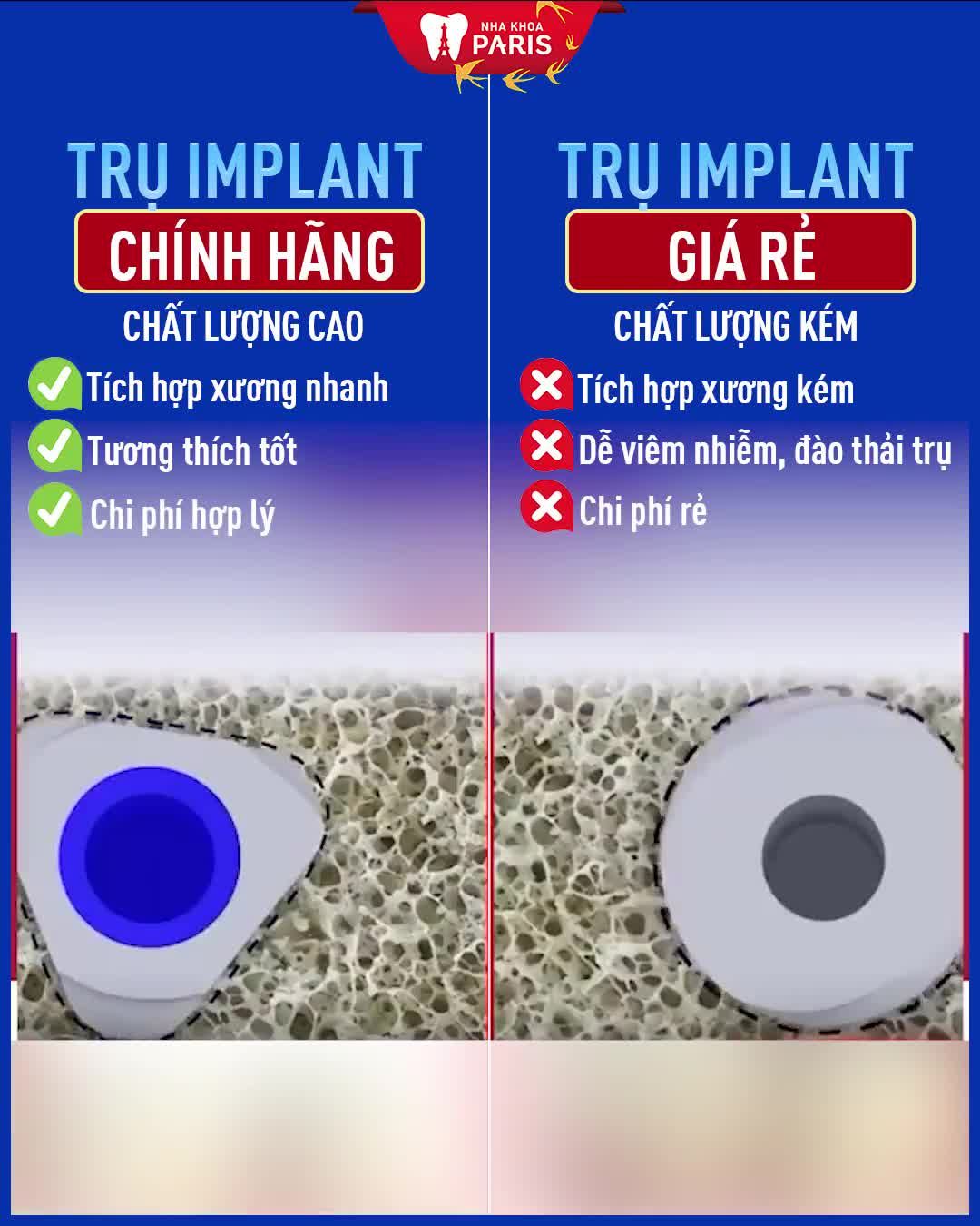 Trồng Răng: Nên Chọn Trụ Implant Đắt hay Rẻ