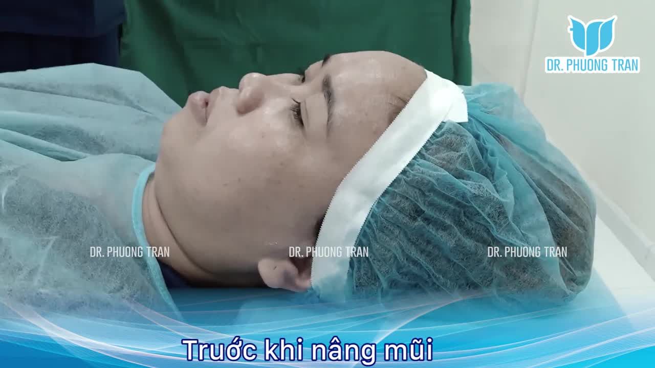 ️Video ghi lại sự thay đổi ngoạn mục của chị ấy sau ca nâng mũi cấu trúc Surgiform.