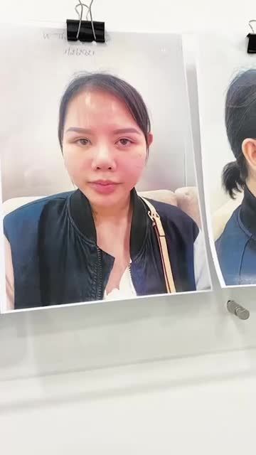 Ca tái tạo cho khách hàng mũi từng nhiễm trùng