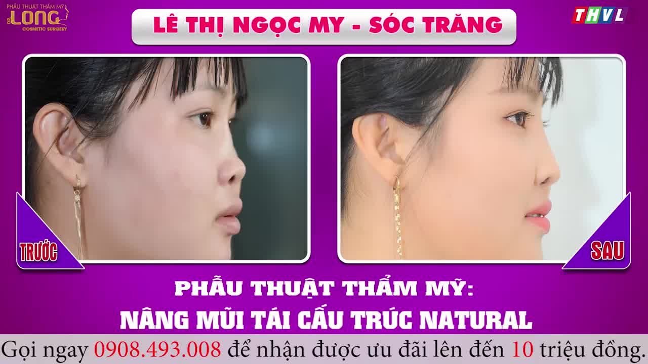 1 năm qua đi kể từ ngày nâng mũi Ngọc My đã thay đổi như thế nào ?