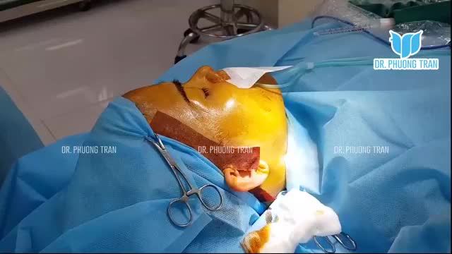 NÂNG MŨI CẤU TRÚC ĐẸP TỰ NHIÊN, HÀI HÒA VỚI GƯƠNG MẶT