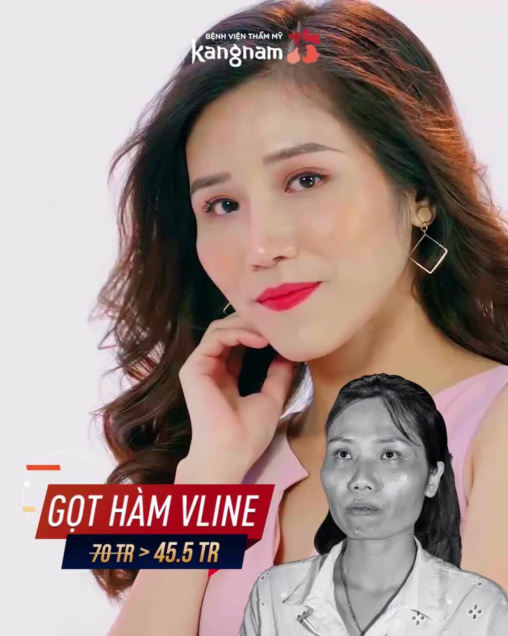 Vừa tung 50 suất ƯU ĐÃI 35% thẩm mỹ HÀM MẶT đã có 31 người nhắn tin đặt gạch rồi ạ!