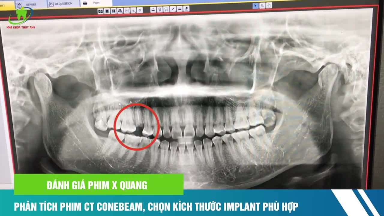 CẬN CẢNH CẤY GHÉP CHÂN RĂNG NHÂN TẠO PHỤC HÌNH RĂNG 15