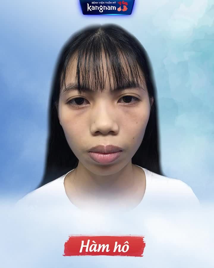 HÀM HÔ 20 năm không dám cười tươi