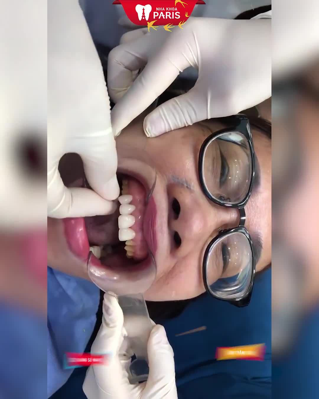 Tạm biệt răng xấu, sứt mẻ, nhiễm màu Không mài răng Không hôi miệng