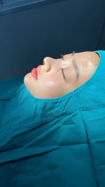 DÁNG MŨI TUYỆT PHẨM NHỜ PHƯƠNG PHÁP NÂNG MŨI CẤU TRÚC SOFTXIL