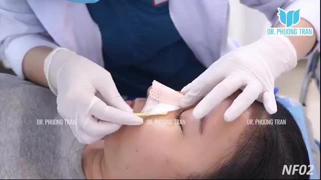 BẤT NGỜ VỚI DIỆN MẠO MỚI SAU 7 NGÀY THÁO NẸP MŨI