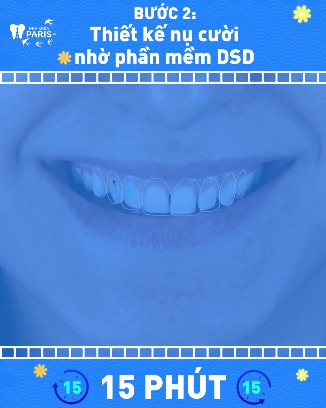 Chỉ 3 Bước Để Răng Hết Xấu Chụp ảnh Thiết kế nụ cười Bọc răng sứ