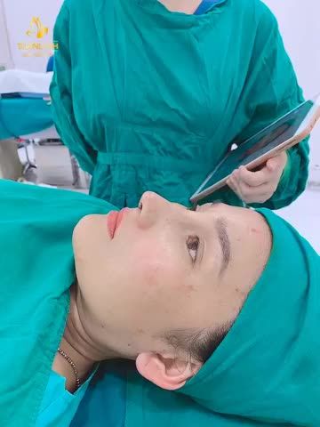 Khách hàng: Nâng mũi siêu cấu trúc sụn Surgiform.