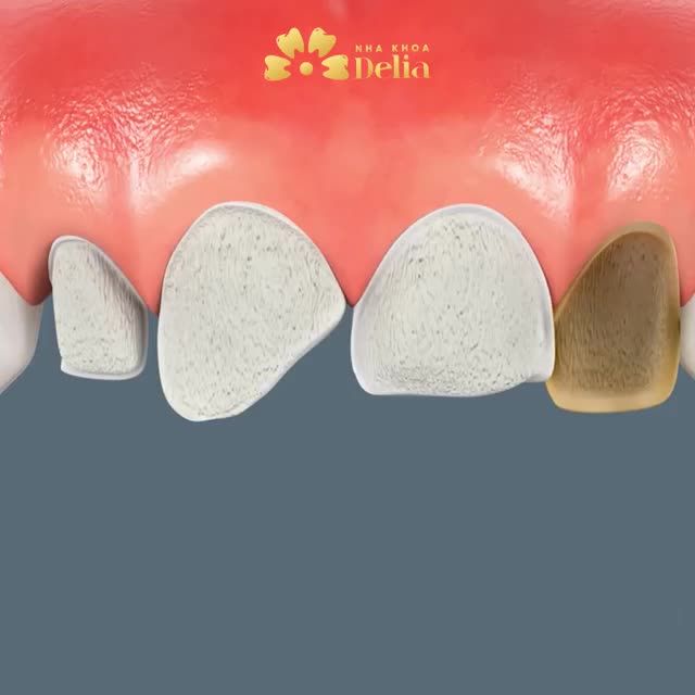 KHÔNG MÀI NHỎ DÁN SỨ VENEER DÀNH CHO BẠN!