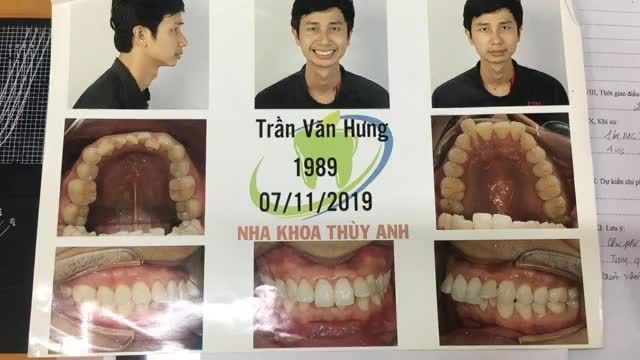 Gắn mắc cài hàm dưới cho anh Hưng điều trị răng hô, lệch lạc.